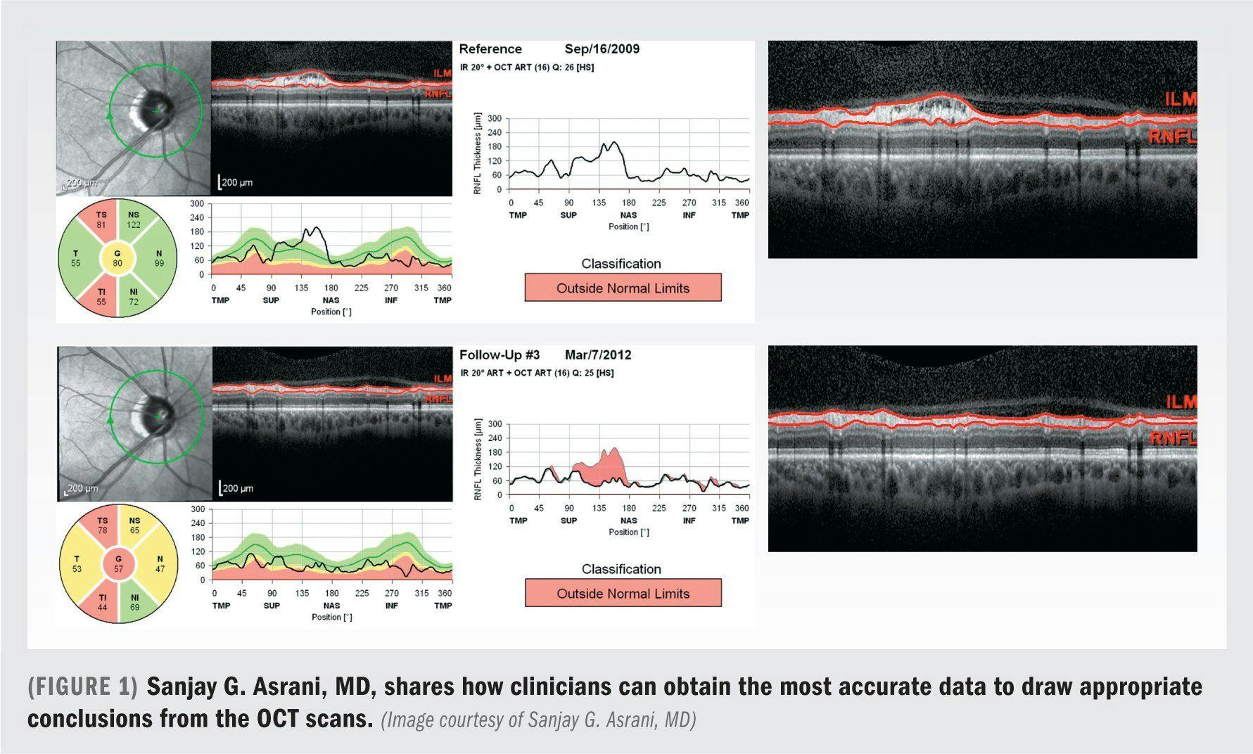 OCT finds niche in glaucoma diagnosis, management
