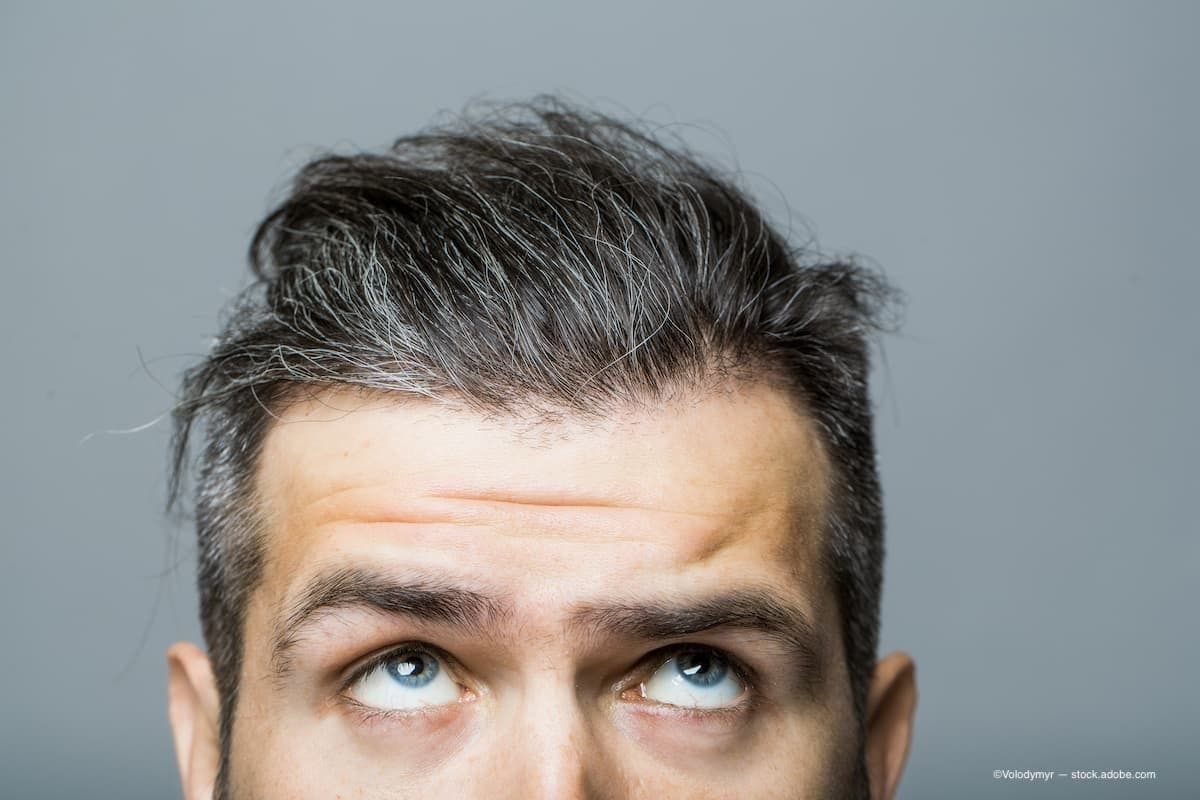 A man with greying hair from the eyes up, looking up at his hair. (Image Credit: AdobeStock/Volodymyr)