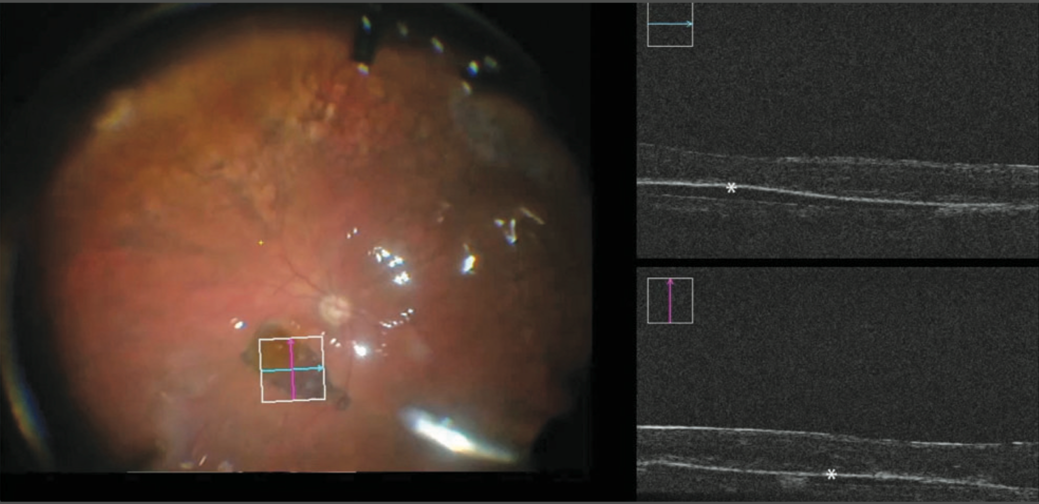 Intraoperative surgical methods key to AMD treatment