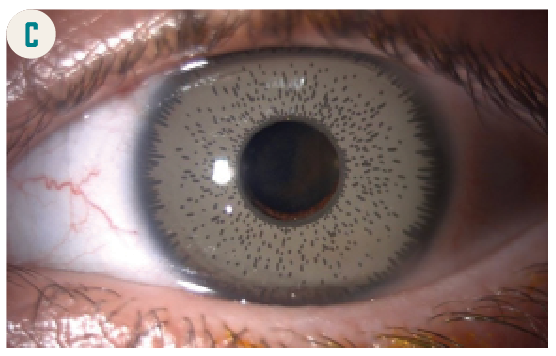 Cosmetic iris implants pose  high risk of vision loss