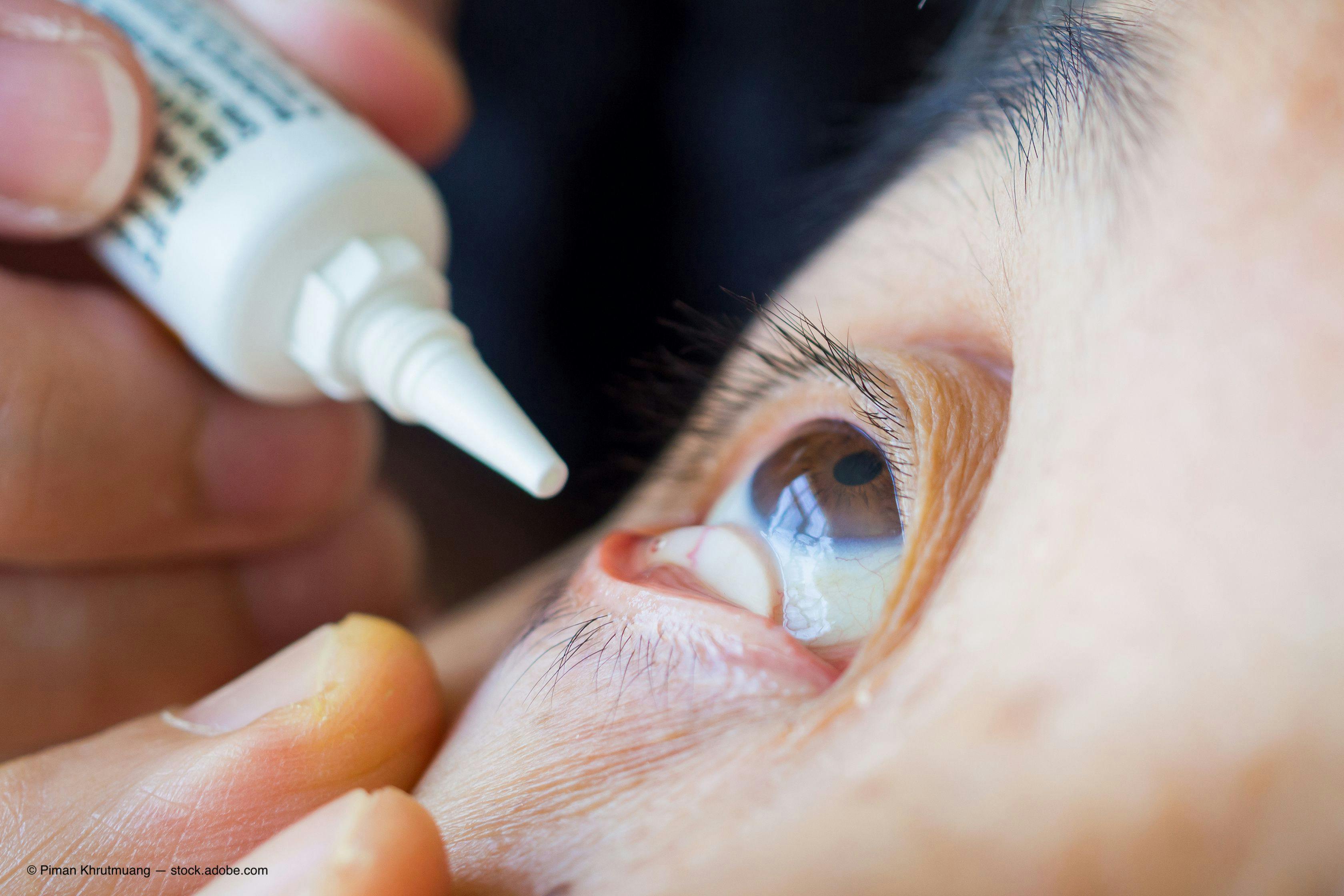 Glaucoma and dry eye present double trouble for patients, ophthalmologists