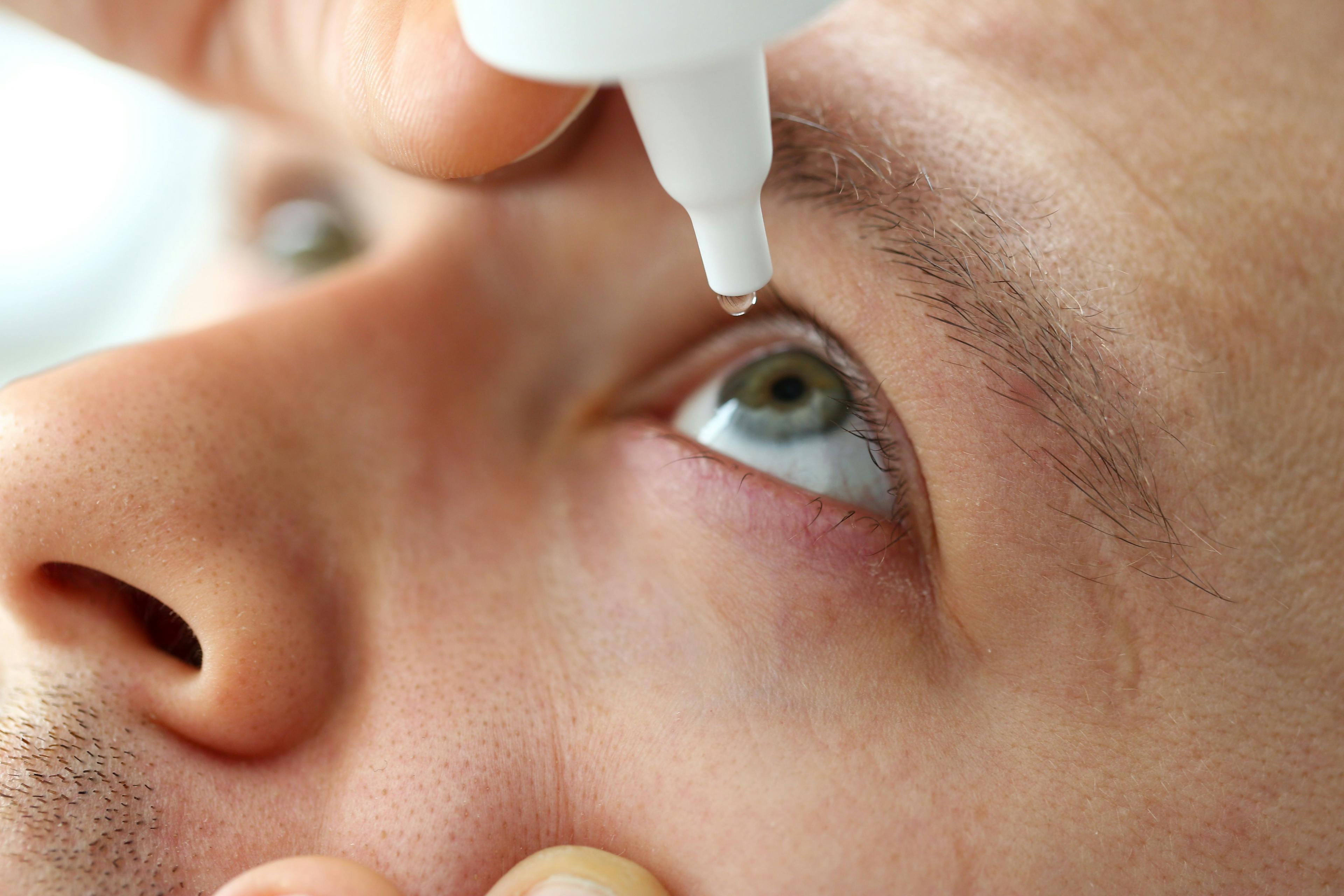 CDC sounds alarm over eye drops linked to dozens of infections, 1 death