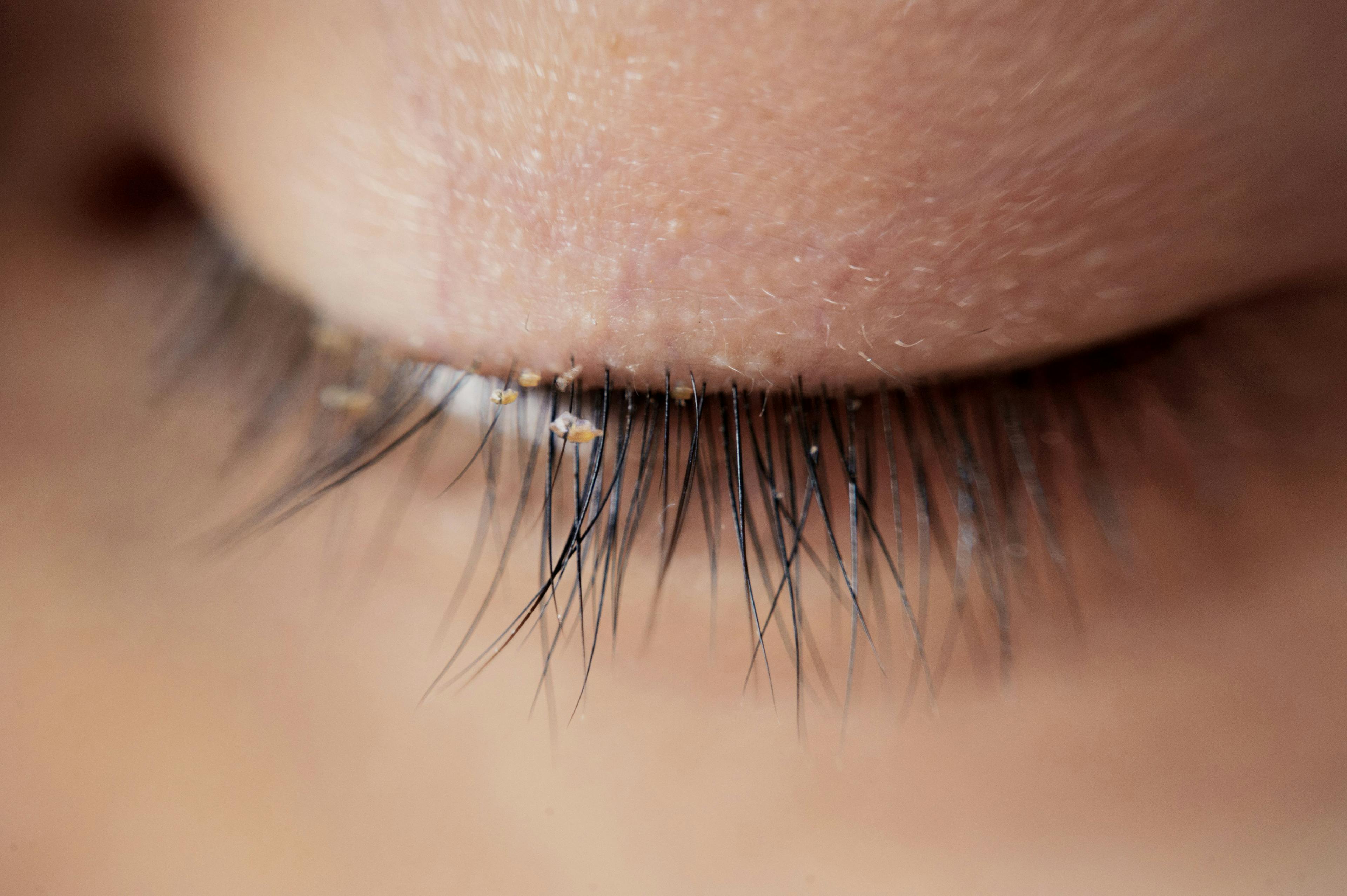 Tarsus is awaiting FDA approval later this year of TP-03, a 0.25% lotilaner ophthalmic solution for the treatment of Demodex blepharitis. (Image courtesy of Adobe Stock/ohishiftl)