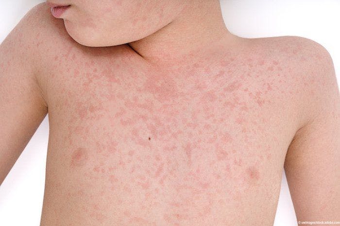 Measles in focus