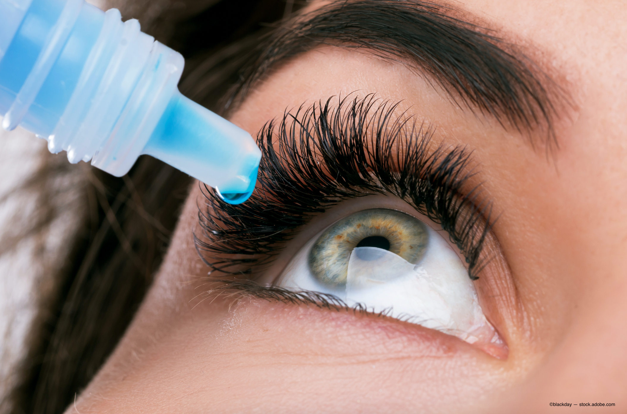 Perfluorohexyloctane ophthalmic solution is the first and only FDA-approved treatment for DED that directly targets tear evaporation. (Image courtesy of Adobe Stock)