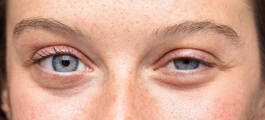 Uplifting ptosis with 2 options: Surgically and pharmacologically