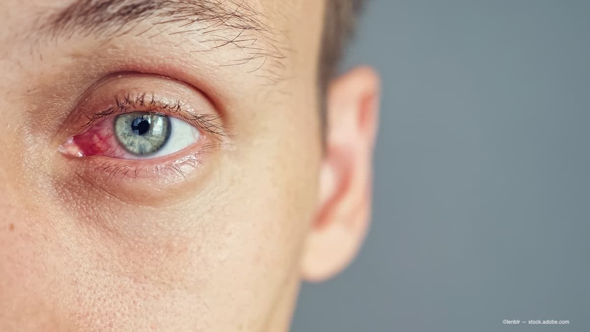 Studies have shown that a single VTP treatment can deliver a sustained improvement in meibomian gland function and reduction in dry eye symptoms over 12 months. (Image Credit: Adobe Stock/lenblr)