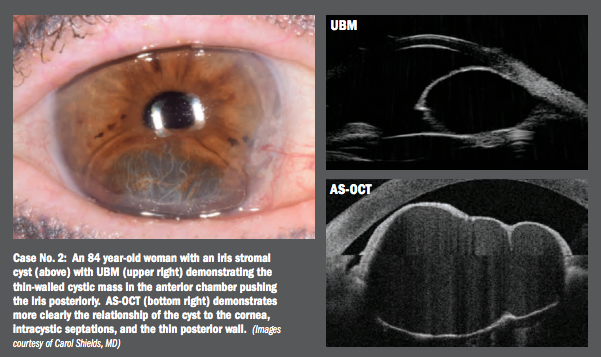 UBM, AS-OCT viable for use with anterior segment lesions 