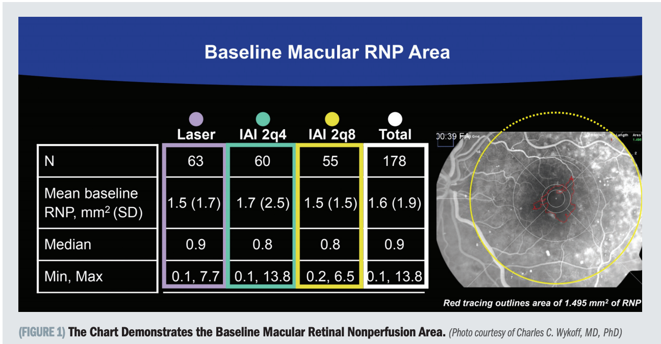 Impact of aflibercept on retinal nonperfusion in DME