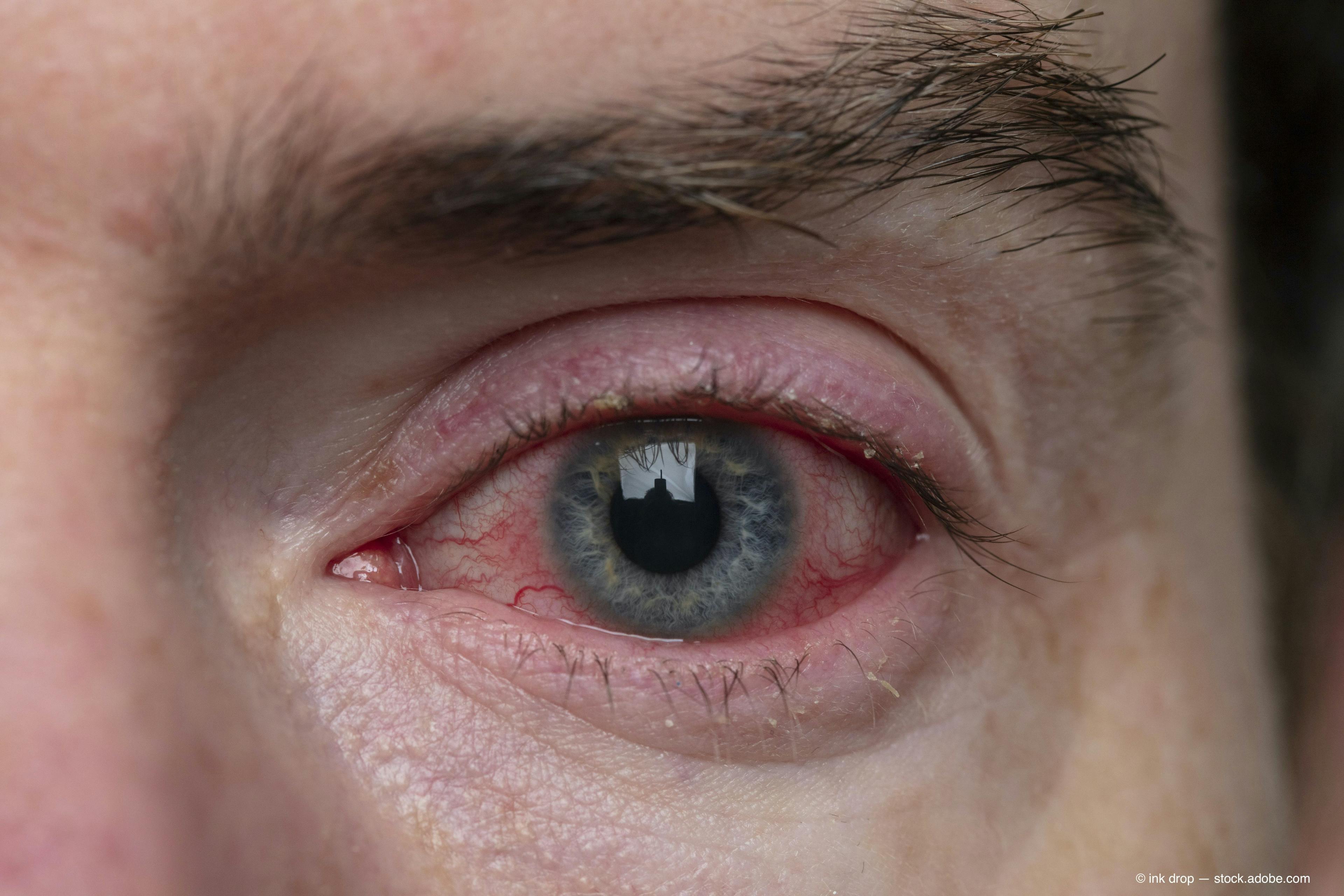 pink eye has been found to be a symptom of coronavirus