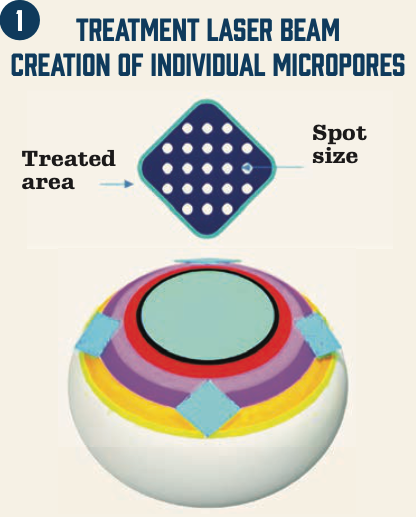Figure 1: In the laser scleral microporation procedure, a matrix of scleral micropores is created in 4 oblique quadrants outside the visual axis.
