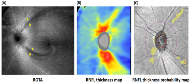 Figure shows superotemporal and inferotemporal retinal nerve fiber layer defects detected by ROTA (yellow arrows) (A) in a patient with early glaucoma that are missed by conventional retinal nerve fiber layer thickness analysis (B and C) – the current clinical standard for detection of glaucoma. (Image courtesy of University of Hong Kong)