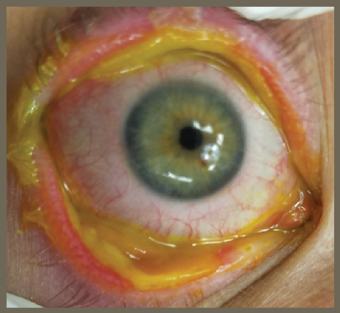 Acute Stevens-Johnson syndrome with severe lid margin inflammation and sloughing of the palpebral conjunctiva. (Image courtesy of Darren Gregory, MD)