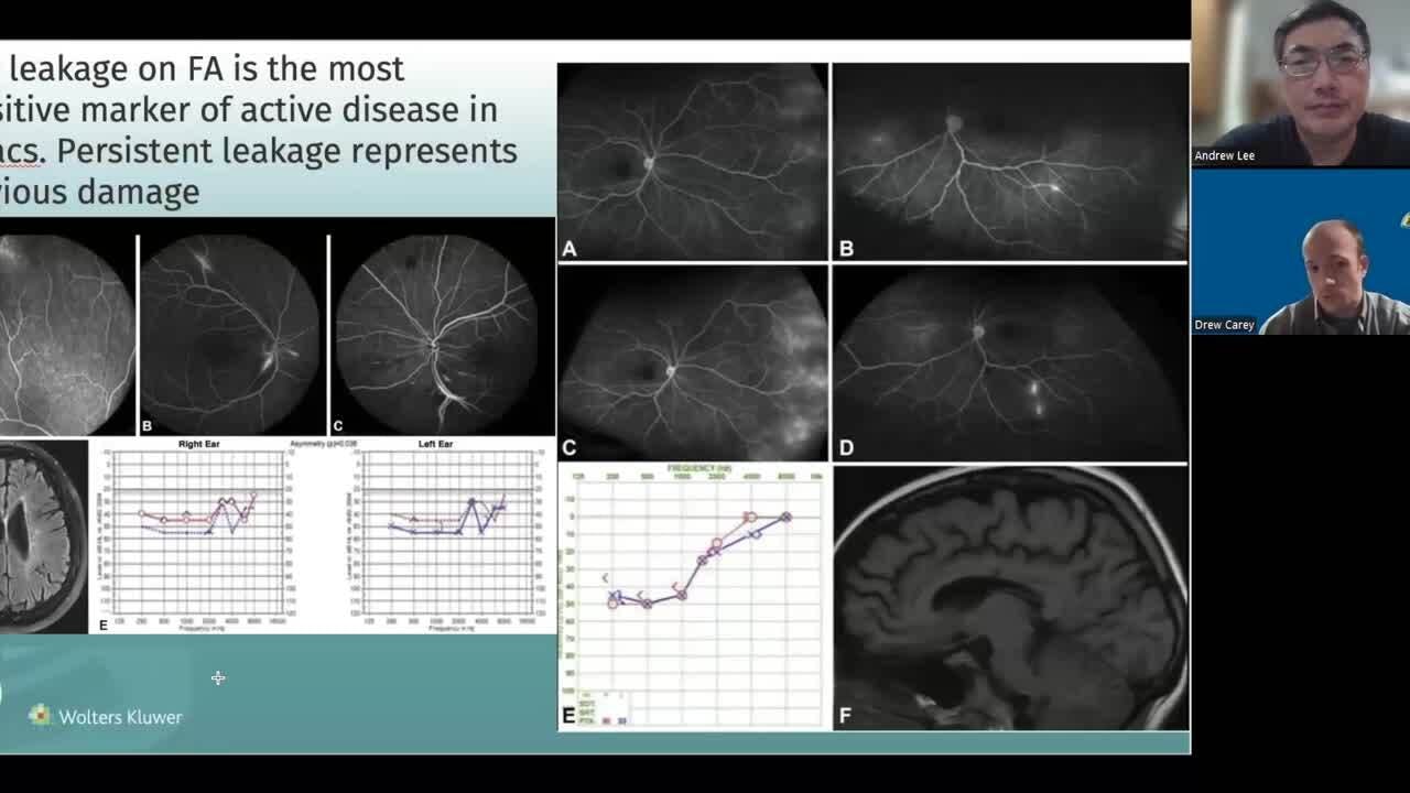 VLOG: NeuroOp Guru: Susac syndrome and fluorescein angiogram