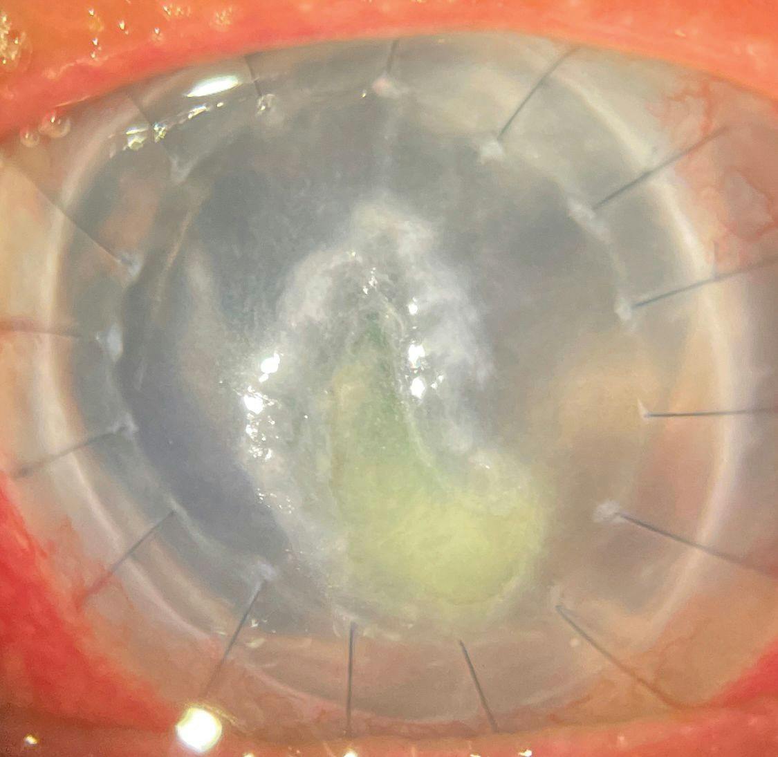 Figure 1. Large Corneal Abrasion. Patient aged 67 years with a previous corneal transplant exhibiting a large corneal abrasion.