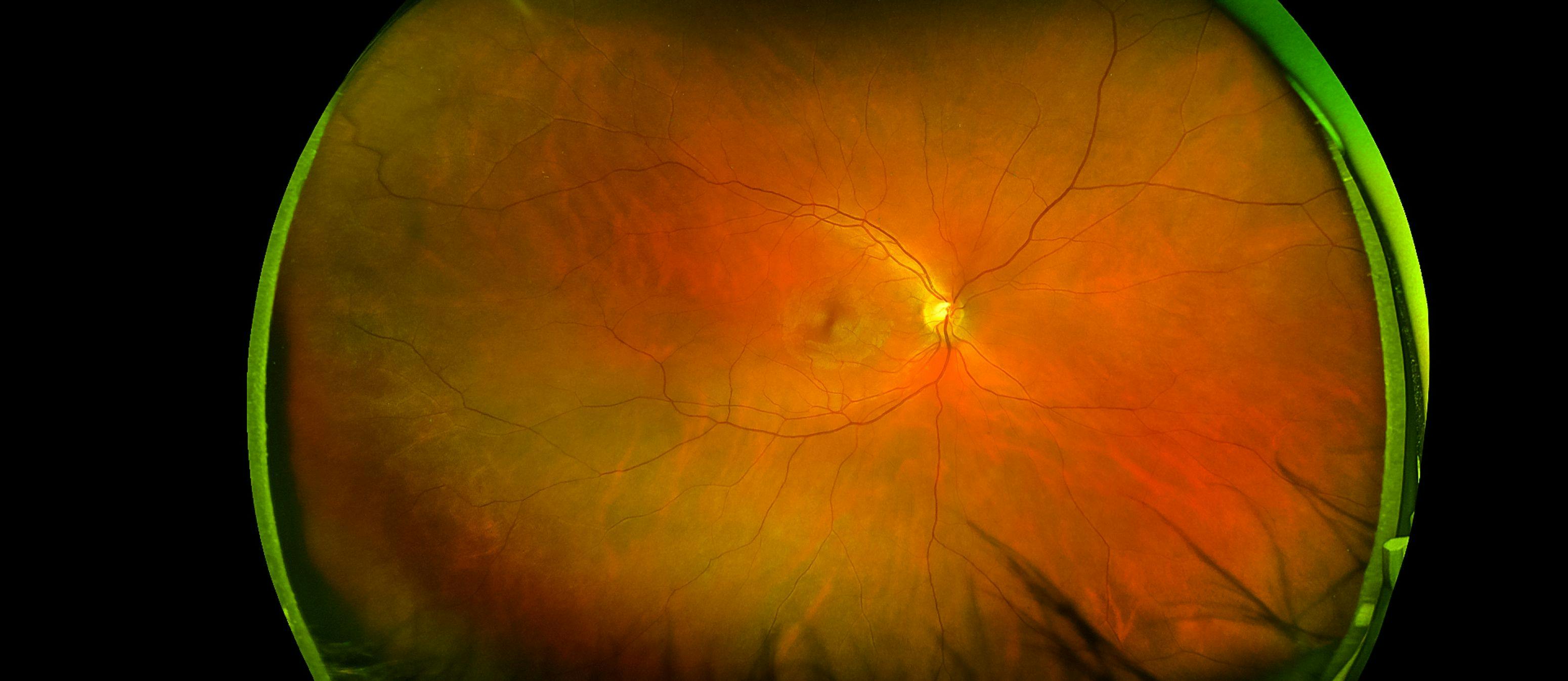 Reti-Intelligence uses a simple fundus camera to capture images of the eye, and then within one minute the AI algorithm provides the disease risk assessment. A general practitioner can perform the retina image capture and if high disease risk is detected, the patient can be referred to a specialist for additional testing.