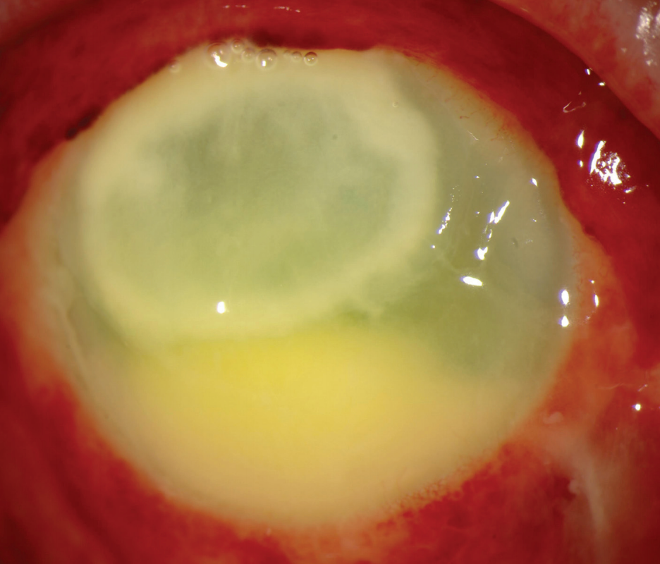 Strategies to address challenging ocular infections