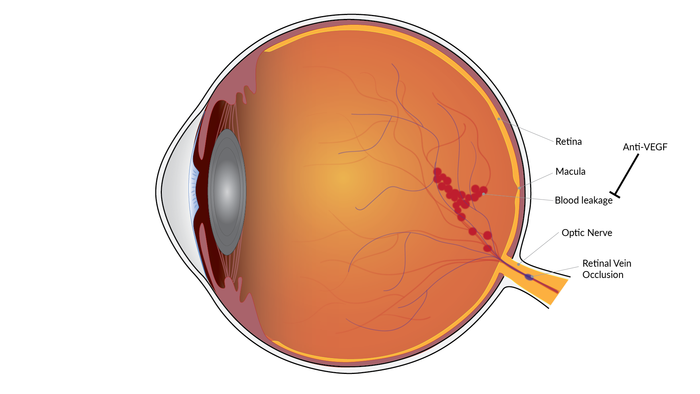 Occlusion of the retinal veins can lead to blood vessel leakage in the retina. (Image courtesy of NEI)