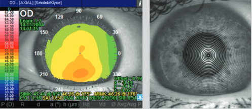 Virtual corneal topography screening 