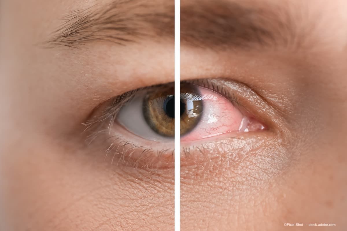 a before and after image of an eye with dry eye with and without treatment. (Image Credit: AdobeStock/Pixel-Shot)