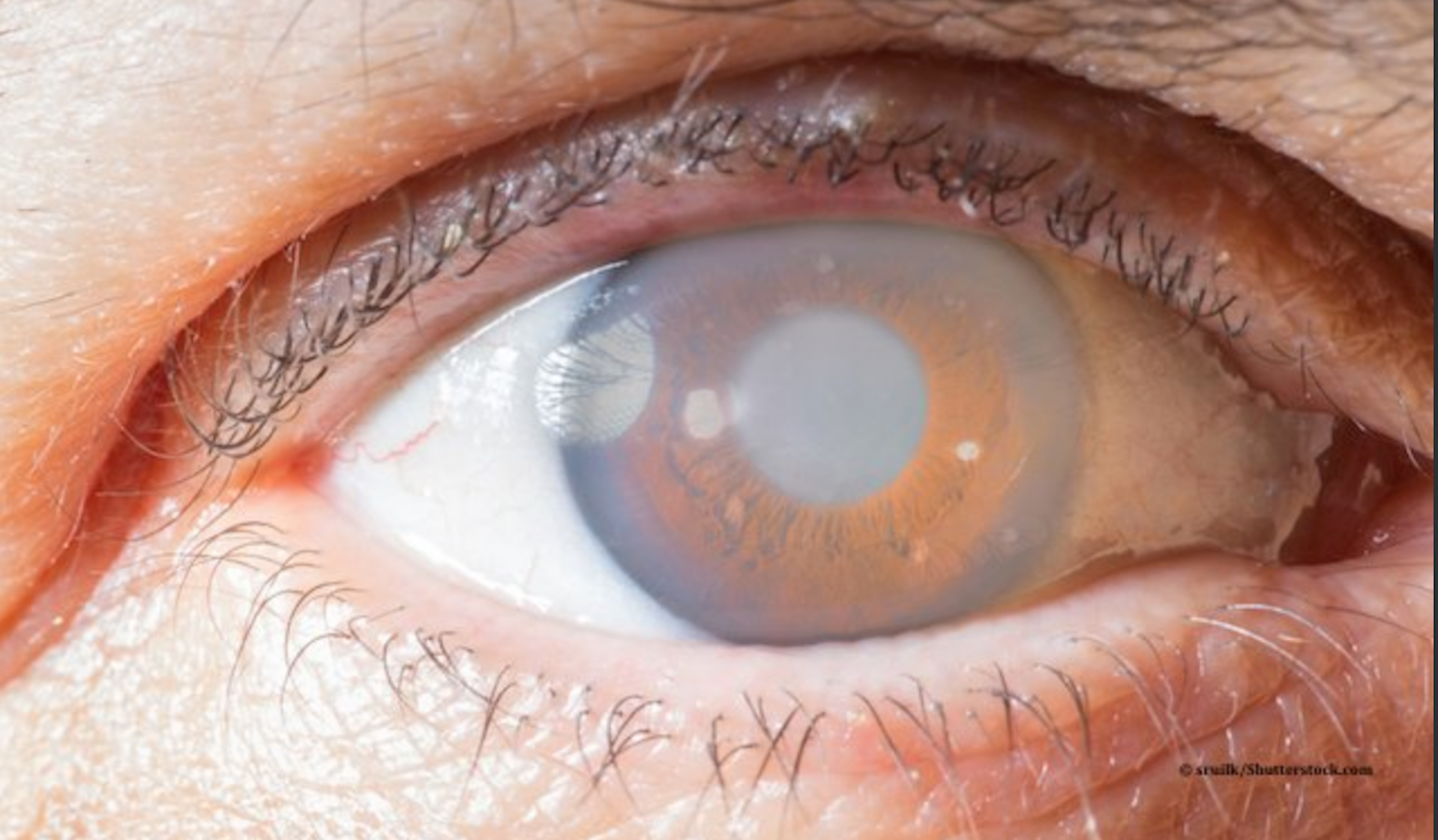 Surgery developed by ophthalmologist at Dean McGee Eye Institute proves its effectiveness