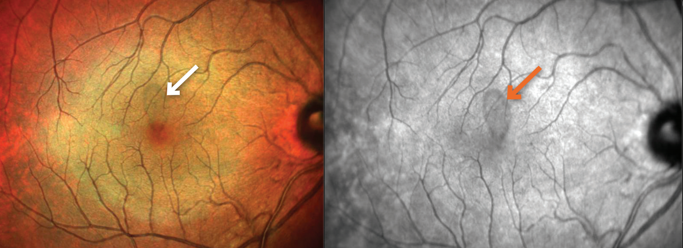 (FIGURE 1) A patient with acute macular neuroretinopathy in the right eye while taking fingolimod. There is subtle petaloid-shaped discoloration, superior to the fovea on multicolor image, and corresponding abnormal signal on near infrared image. (Photos courtesy of Bradley T. Smith, MD)