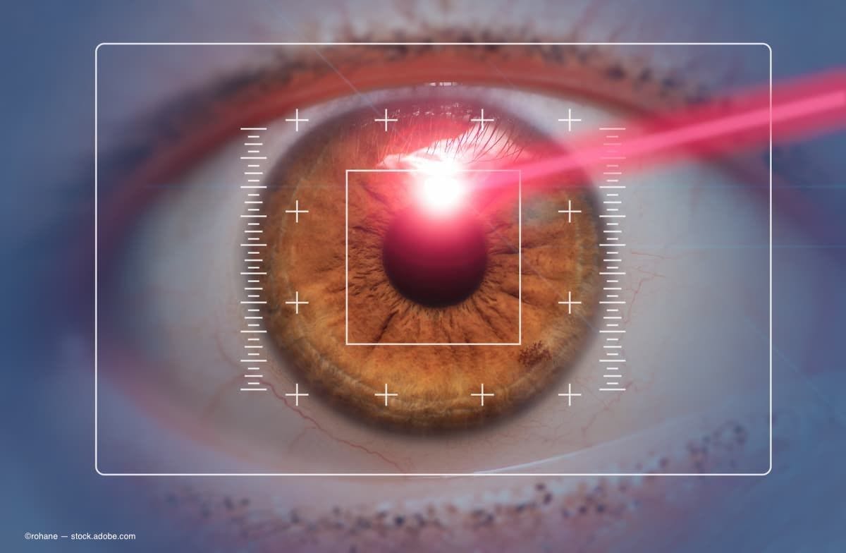 a close image of an eye with a laser going into it for surgery. (Image Credit: AdobeStock/rohane)