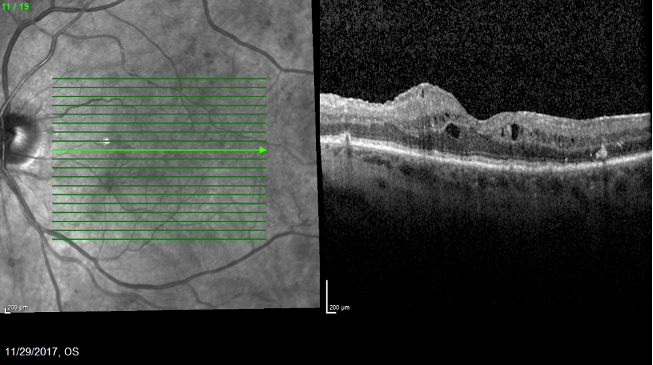 Figure 1. An OCT imaging showed evidence of macula edema. (Images courtesy of Caesar K. Luo, MD, FACS, FASRS)