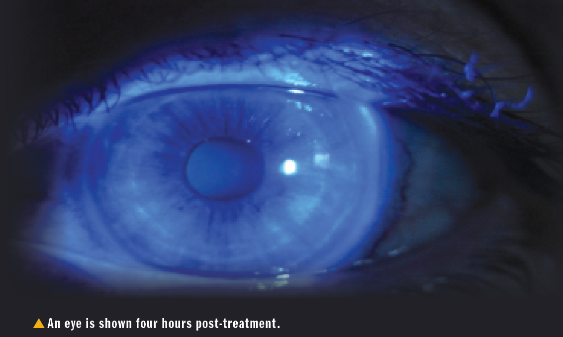 Eye shown 4 hours post-treatment