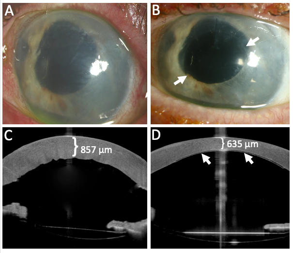 FIGURE 2. Slit-lamp pictures and OCT images before (A+C) and 12 weeks after implantation (B+D). Significant corneal oedema is shown in A and quantified via OCT in C. Marked resolution of corneal oedema 12 weeks after implantation is shown in B. Significant reduction in corneal thickness is measured by means of OCT in D. The white arrows show the outlines of the implant on the posterior surface of the cornea in B and D.