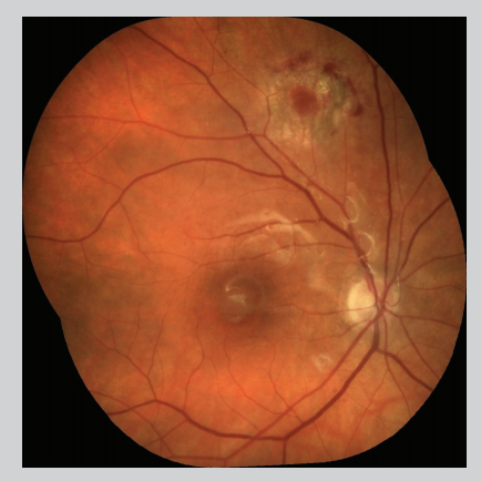 Pearls for optimizing patient outcomes of macular surgery