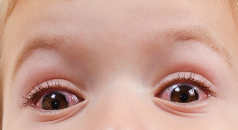 Investigators study COVID-19 ocular manifestations in children in China