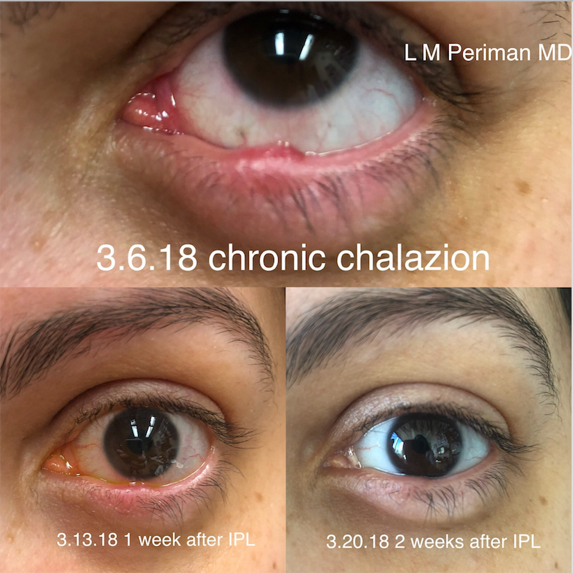 Treating chalazion with IPL therapy