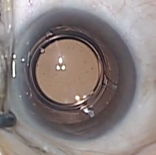 Multicomponent IOL offers solution for perfecting vision outcomes after cataract surgery