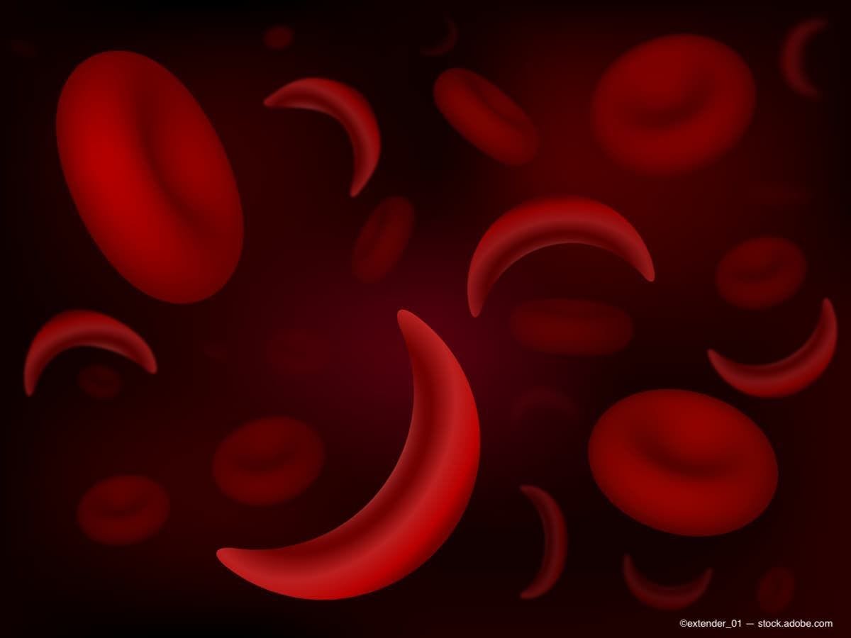 AAO 2023: Study finds children diagnosed with sickle cell disease seem to suffer eye issues at same rate as adult patients