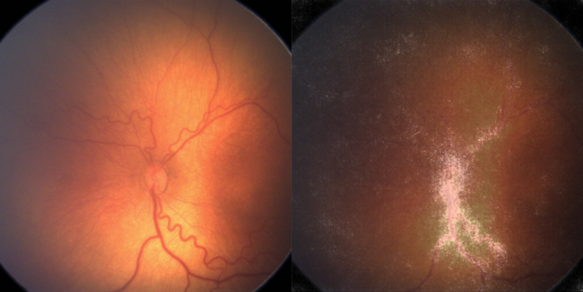 On the left, a photograph of the left retina of a neonate (newborn infant) with retinopathy of prematurity. The image on the right has an overlaid saliency map generated by the AI algorithm, which shows the parts of the image most influencing the algorithm decision-making. (Image courtesy of Moorfields Eye Hospital)