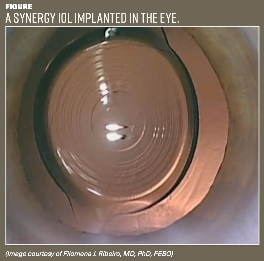 A SYNERGY IOL IMPLANTED IN THE EYE