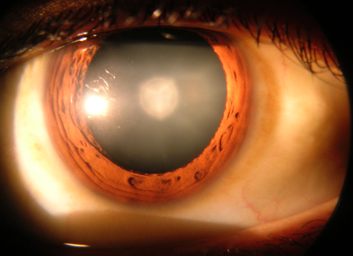 NEI-supported study to focus on causes of cataracts