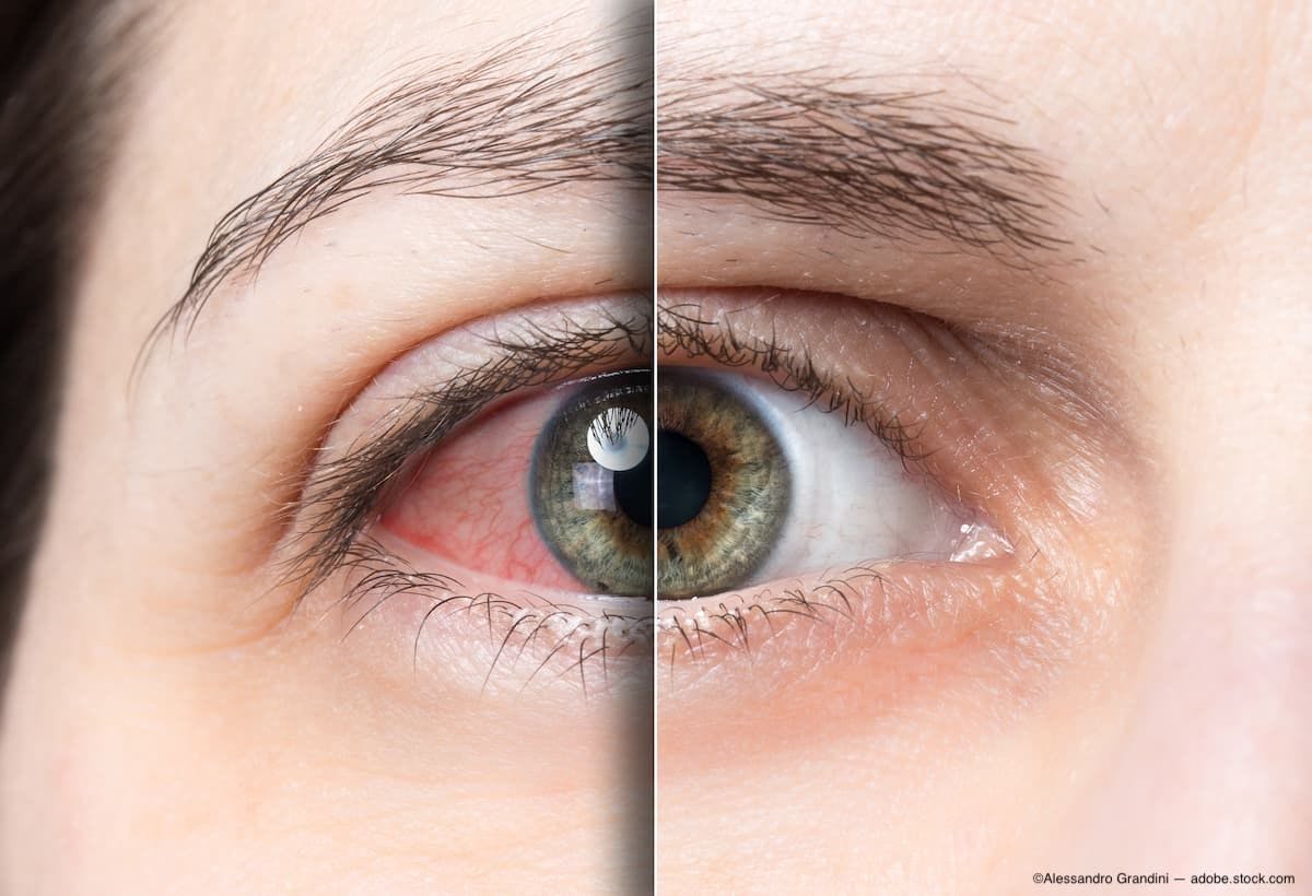 Diagnosis and treatment: Manage dry eye with these tips