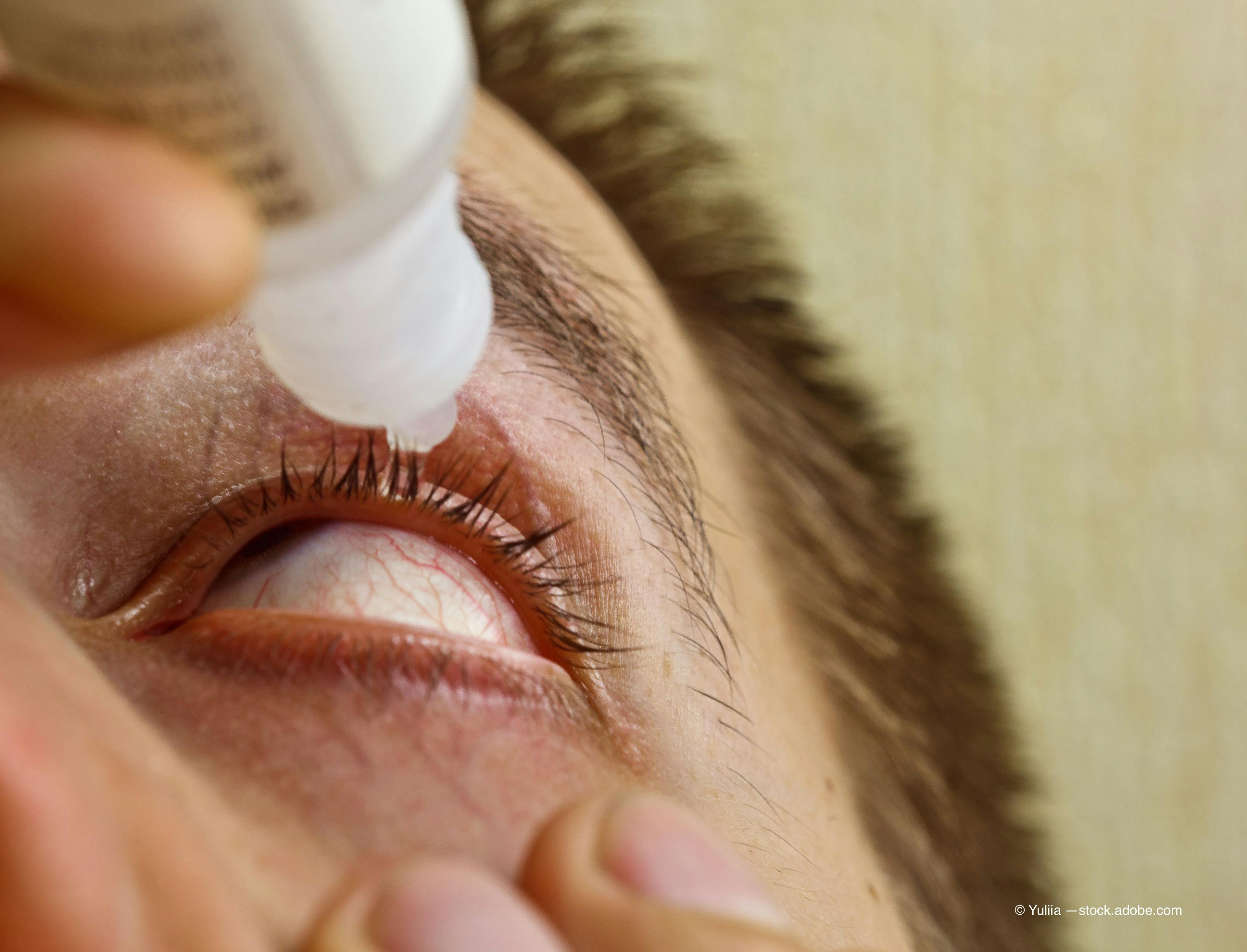 Zeroing in on dry eye treatment for patients with cataracts