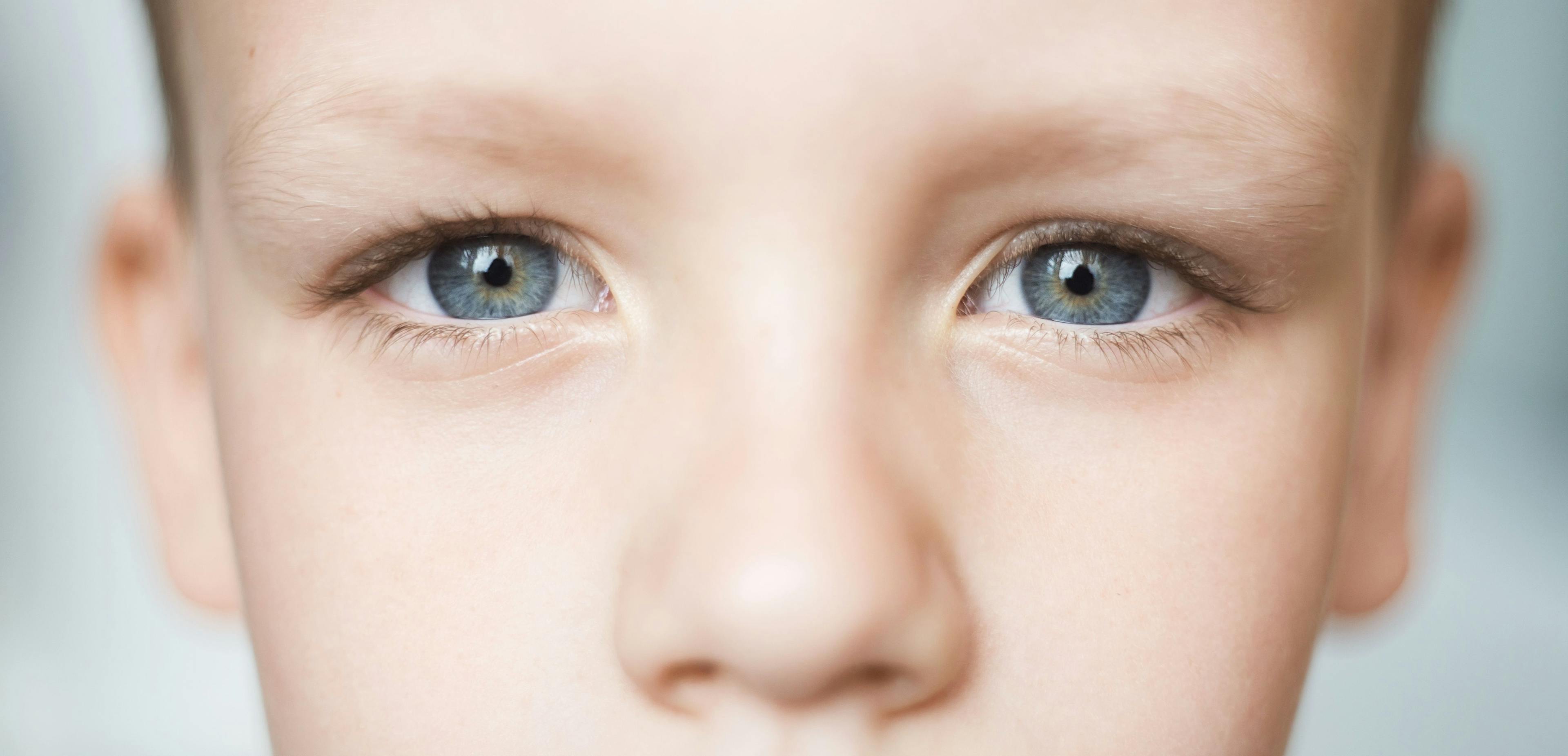 The finding of the low level of hyperopia seen at a median of 5.1 years of age suggested that patients will become myopic as they get older.