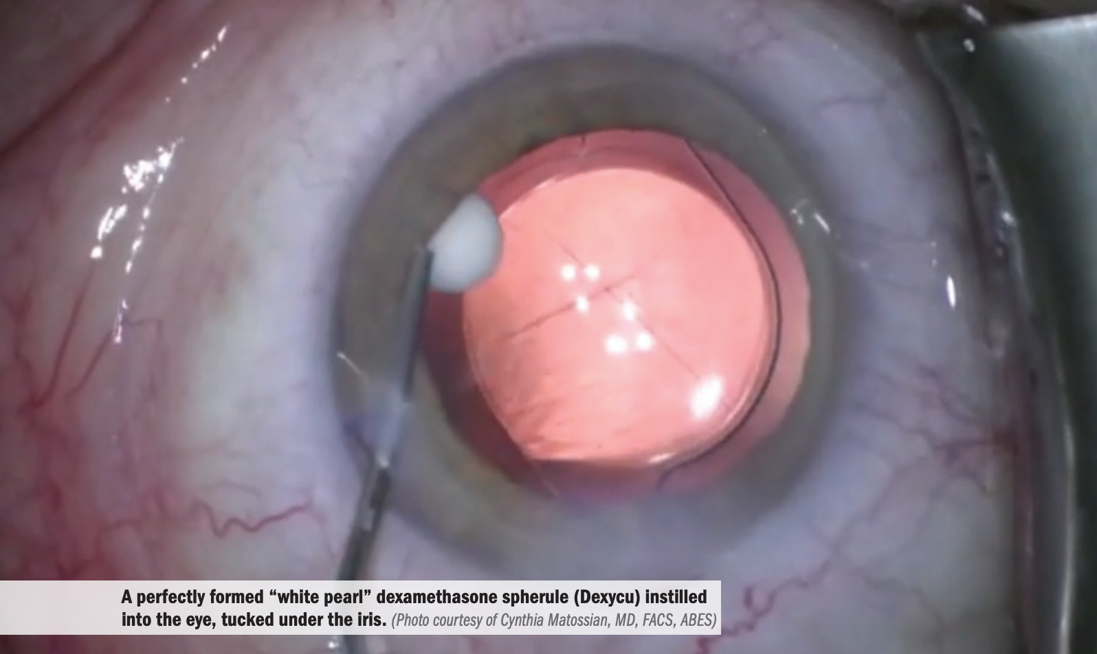 Challenges to topical drop adherence after cataract surgery