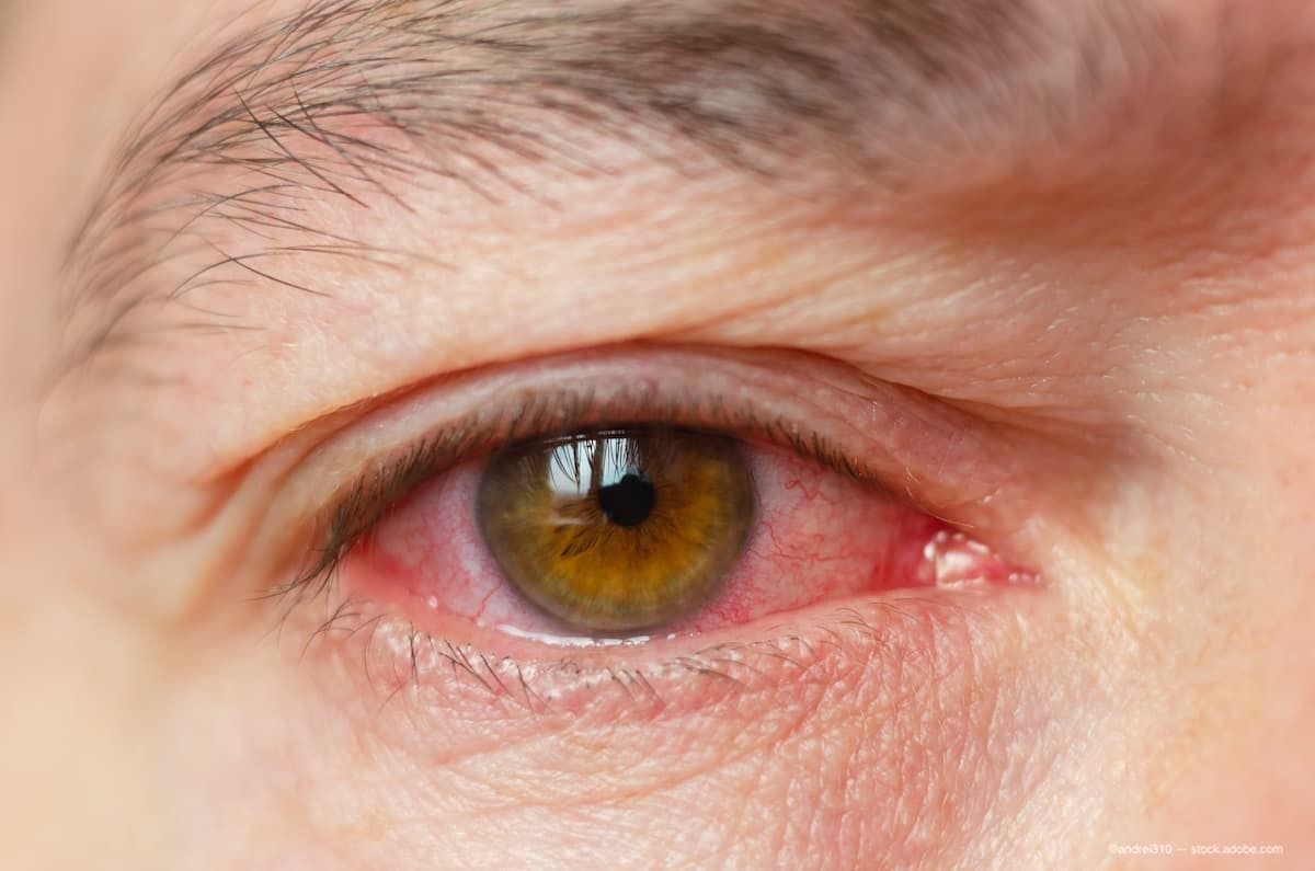 an image of a man suffering from pink eye. (Image Credit: AdobeStock/andrei310)