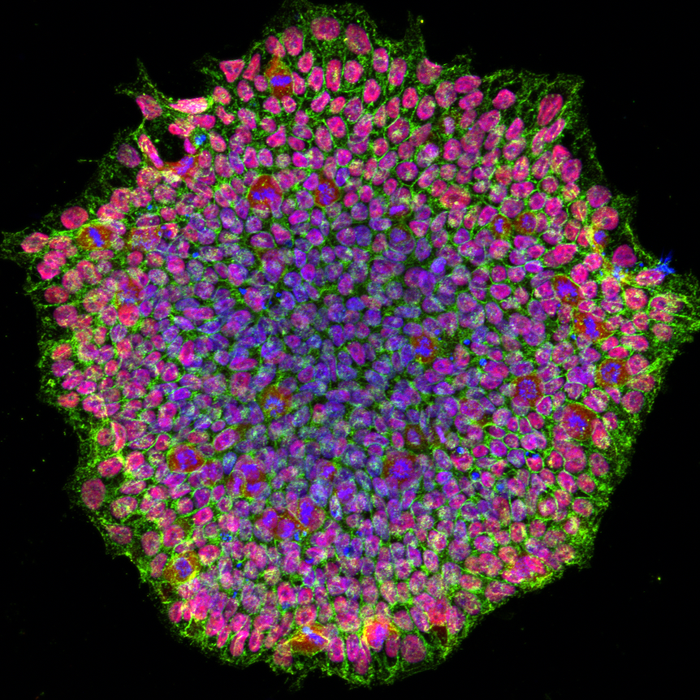 A human induced pluripotent stem cell colony from OCA1A patient. The image was acquired using a confocal microscope and is stained for pluripotency marker proteins. The red color depicts transcription factor OCT4, green is SSEA4 protein and blue represents the nucleus of the cells. (Image courtesy of the National Eye Institute)