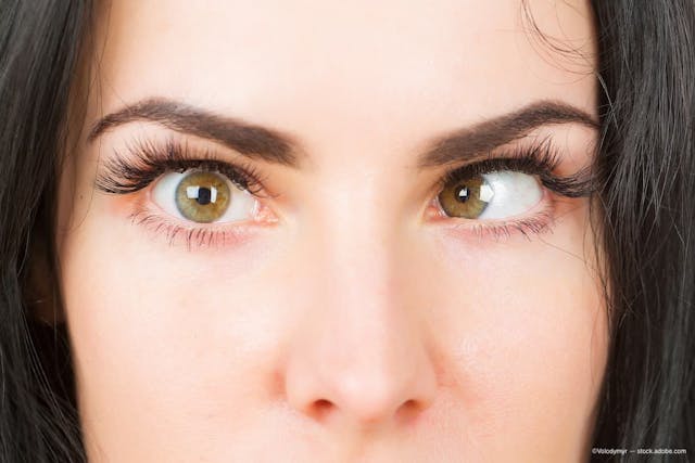 Botulinum toxin injections offer an alternative to extraocular muscle surgery for comitant esotropia
