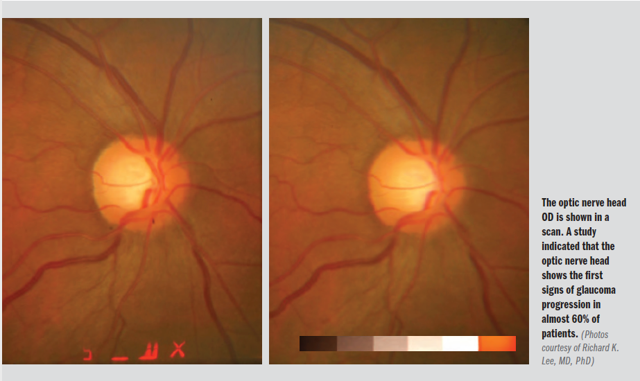 Optic nerve head OD shown in an OCT indicates glaucoma progression 