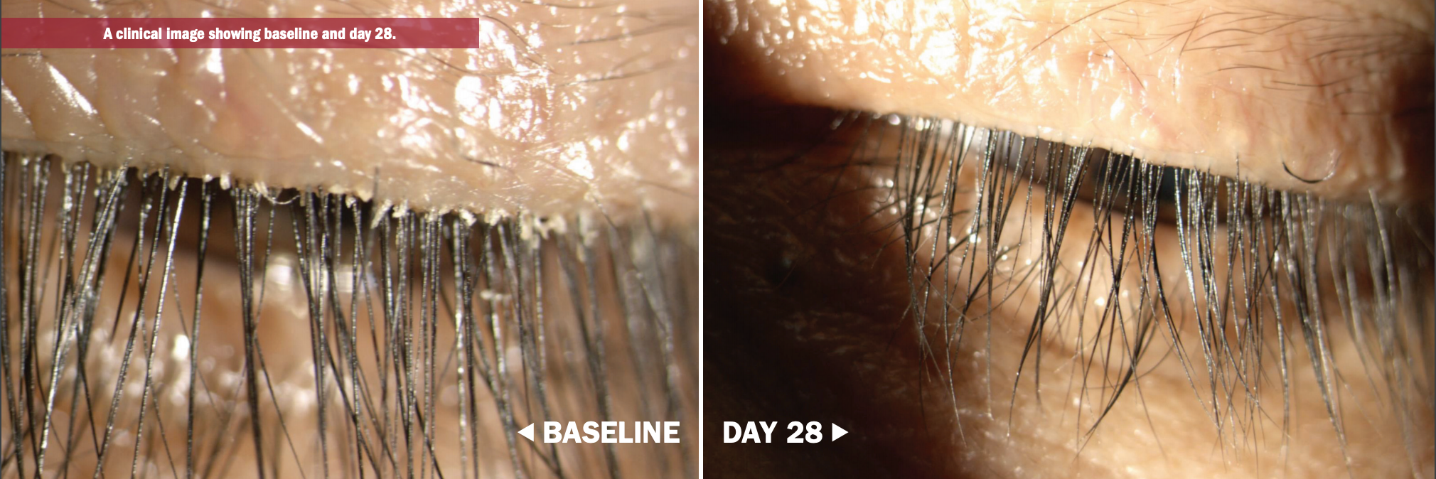 Drop shows effectiveness for Demodex blepharitis in phase 2a study
