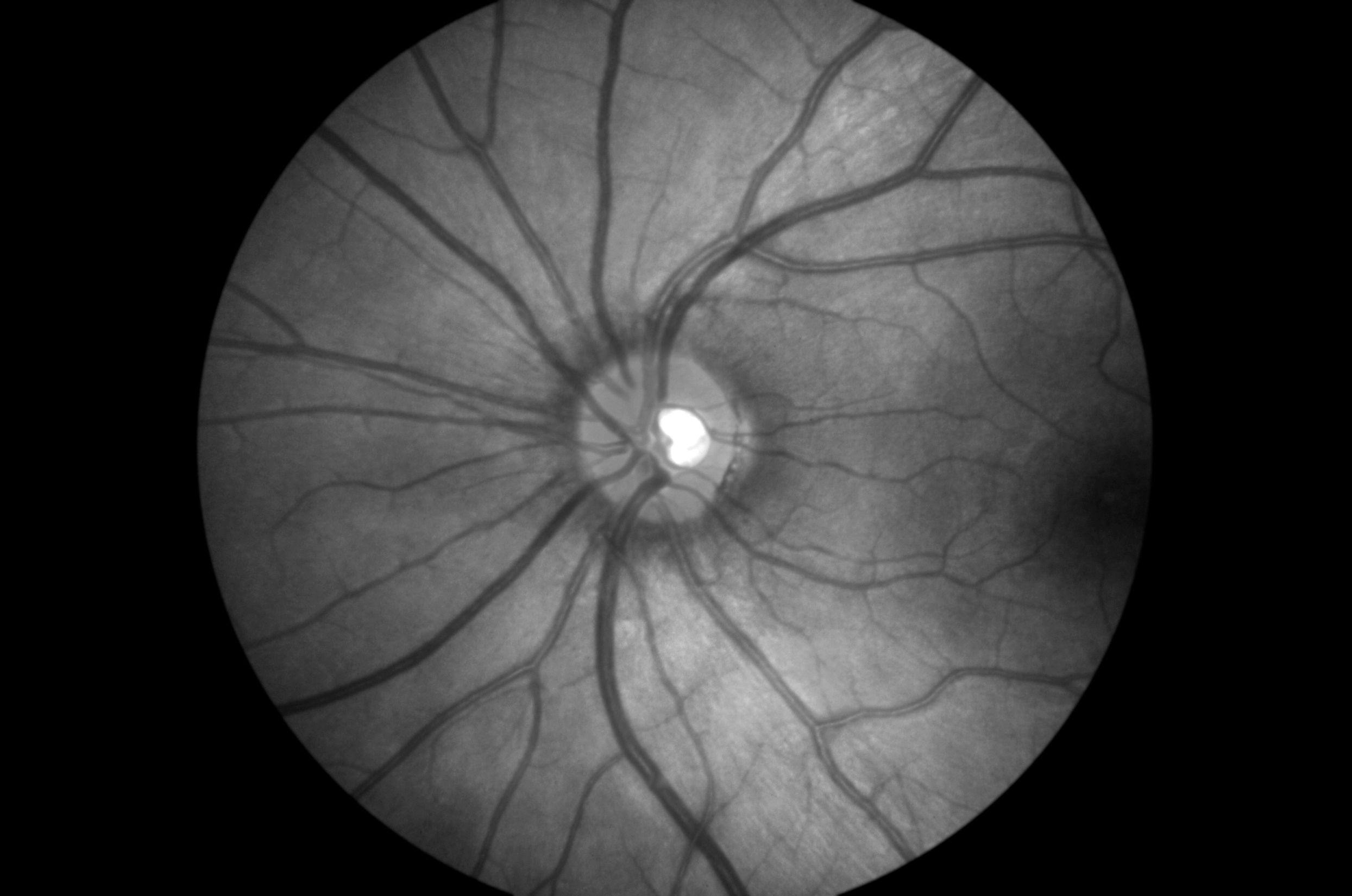 Retinal pathologies challenging to image with current technologies 
