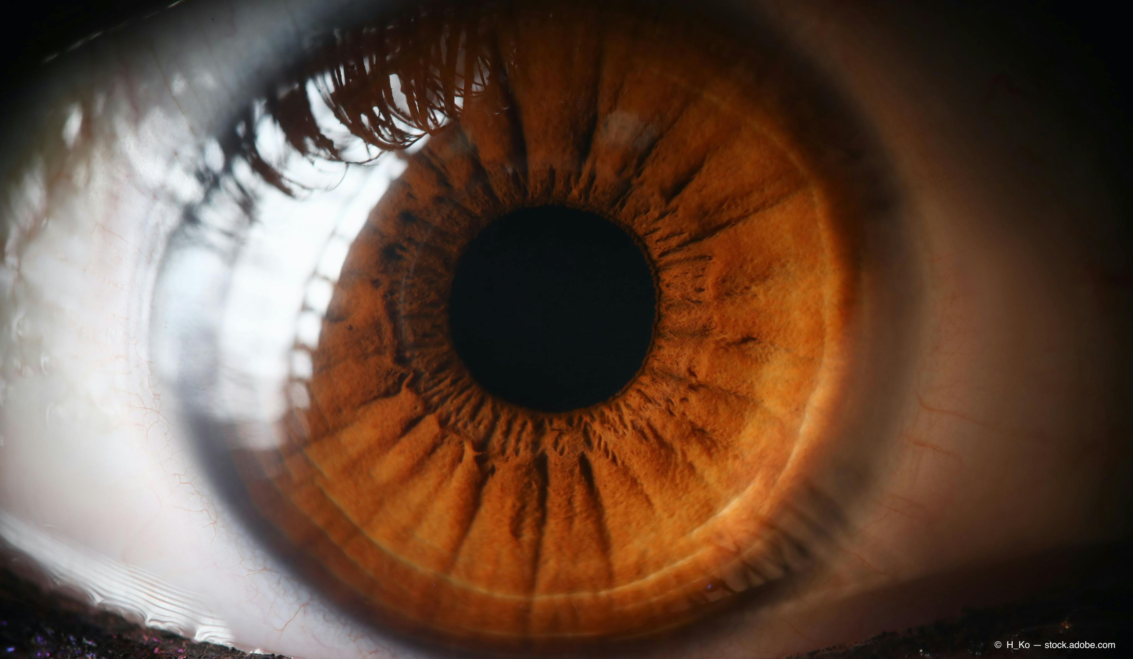 Protocol T Extension Study shows long-term visual declines in DME eyes