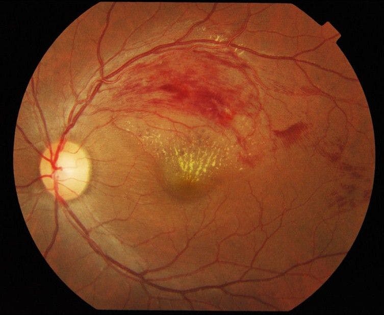 NIH study finds vision improvement is long-lasting with treatment for blinding blood vessel condition